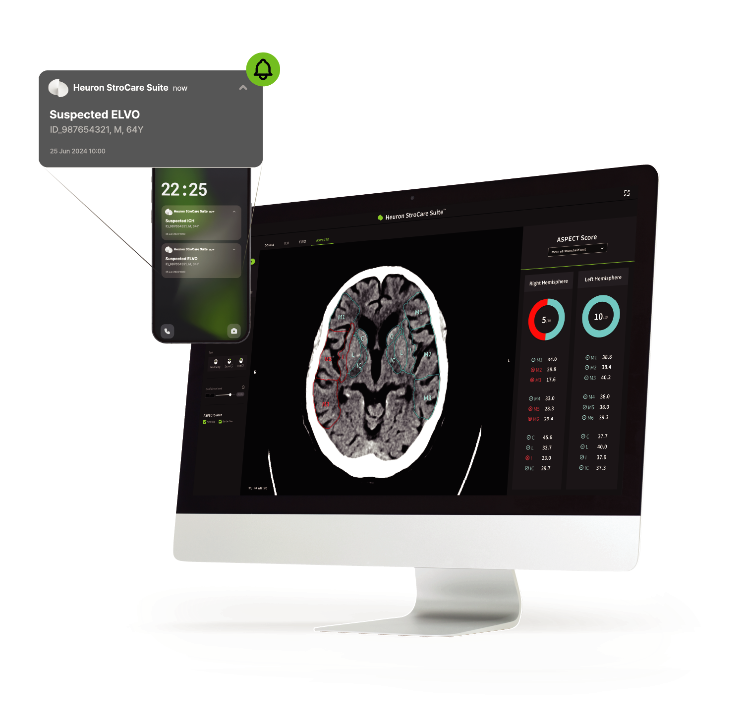 "佑榮"腦中風輔助診斷系統